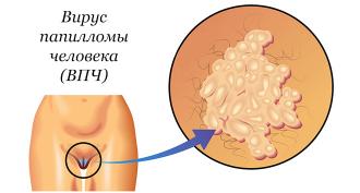 Ιός ανθρωπίνων θηλωμάτων και κυστίτιδα Θεραπεία της τραχηλίτιδας που προκαλείται από τον HPV